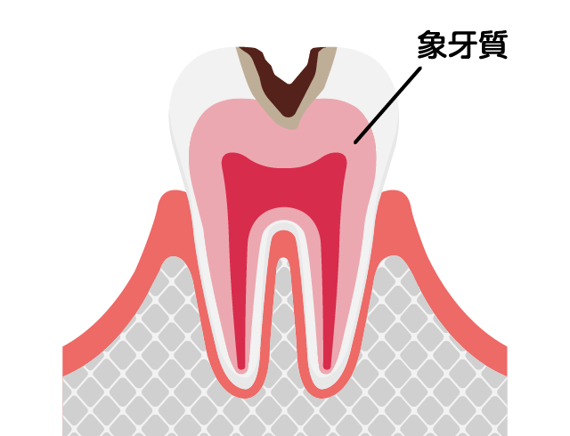 歯の内部の象牙質まで進行したむし歯